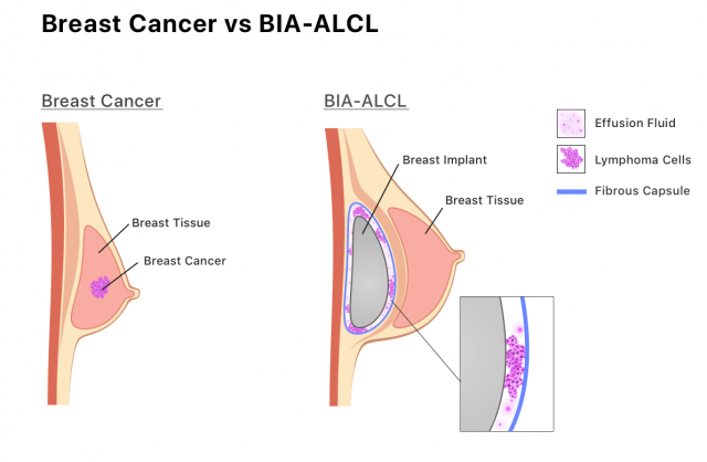 显示BIA-ALCL如何在液体或疤痕组织中发展的信息图