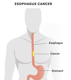 人类食管癌的图示。