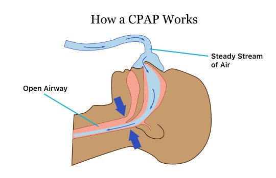 显示CPAP如何治疗睡眠呼吸暂停的图像