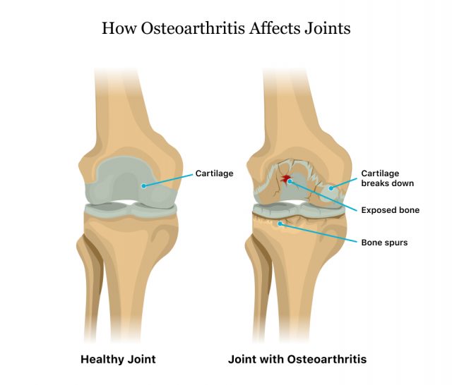 骨关节炎如何影响关节