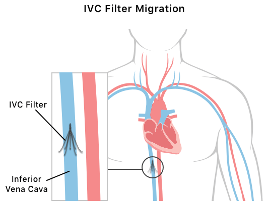 下腔静脉滤镜穿孔图
