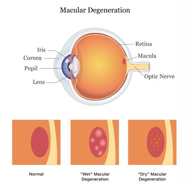 湿性与干性黄斑变性