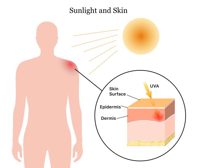阳光如何导致晒伤皮肤