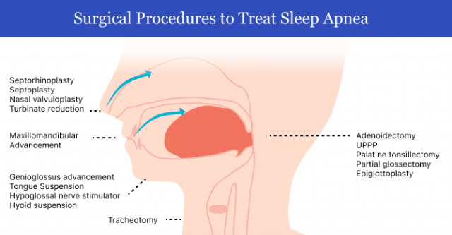 治疗睡眠呼吸暂停的手术程序