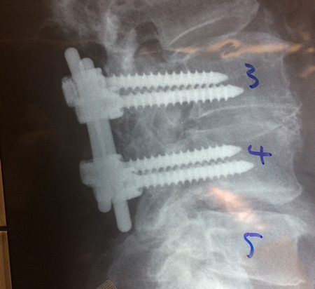 椎体螺钉和杆的x光片