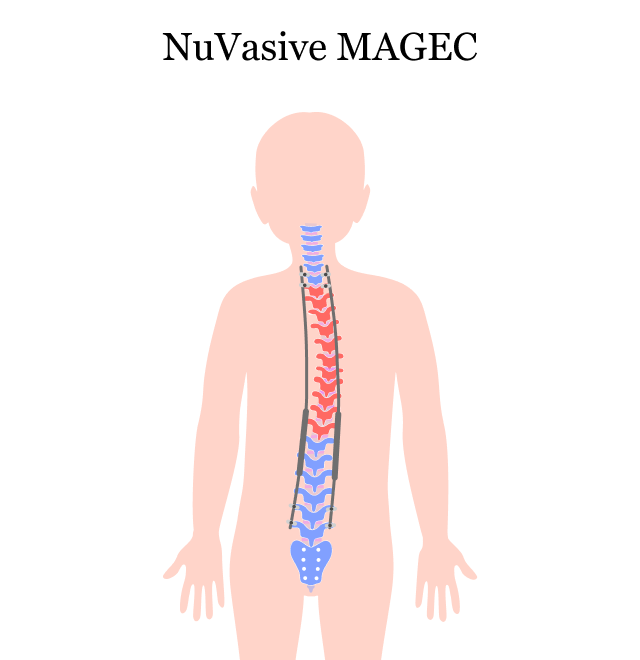 NuVasive MAGEC系统帮助患有早期脊柱侧弯(EOS)的儿童矫正脊柱。