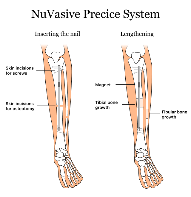 图示显示NuVasive的Precice系统如何处理肢体长度差异