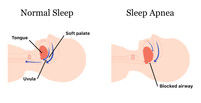 图示正常睡眠与睡眠呼吸暂停时的口腔情况