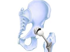 Stryker髋关节置换